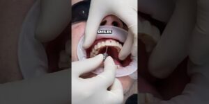 Are dental implants better than veneers