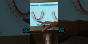 Smile Simulation! Before and After