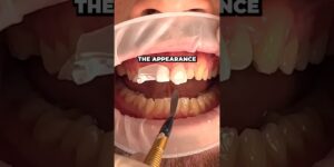 What’s The Difference Between a Crown and a Veneer?