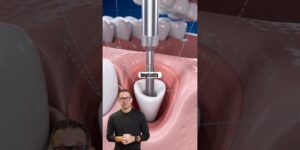 Should you replace your teeth with dental implants Cosmetic dentist Dr. Andrew Hall explains
