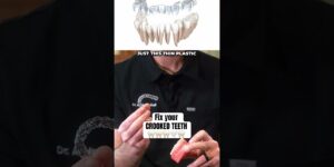What are clear aligners for your teeth?